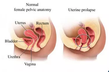 uterine fibroid treatment in gurgaon