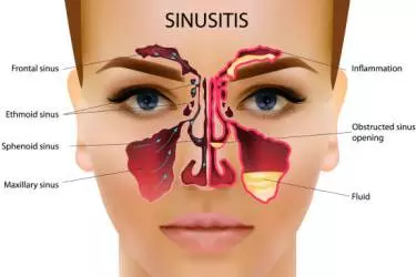 best doctor for sinus treatment in gurgaon, treatment of sinus probllem without surgery, best hospital for treatment of sinus in gurgaon, endoscopic sinus surgery in gurgaon, cost of sinus surgery in gurgaon